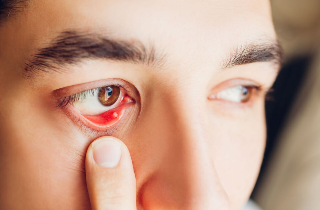 Can Accutane Cause Dry Eyes?